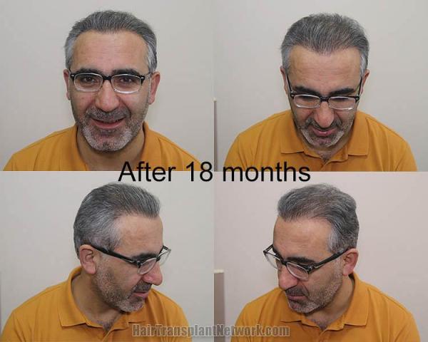 Hair transplant surgery before and after photos