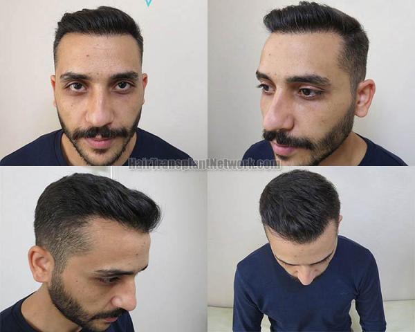 Hair restoration surgery after photos