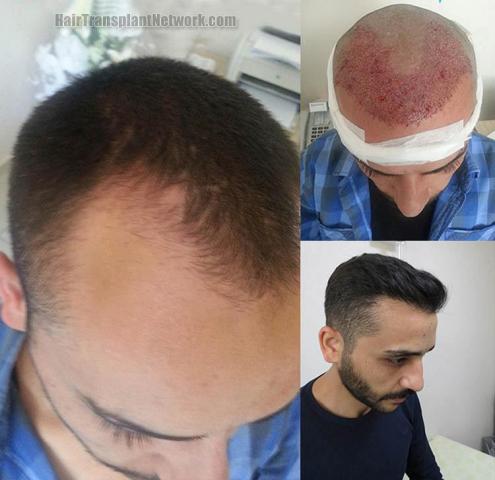 Hair transplantation surgery before and after photos