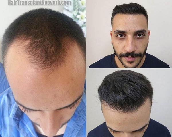 Hair transplantation surgery before and after pictures