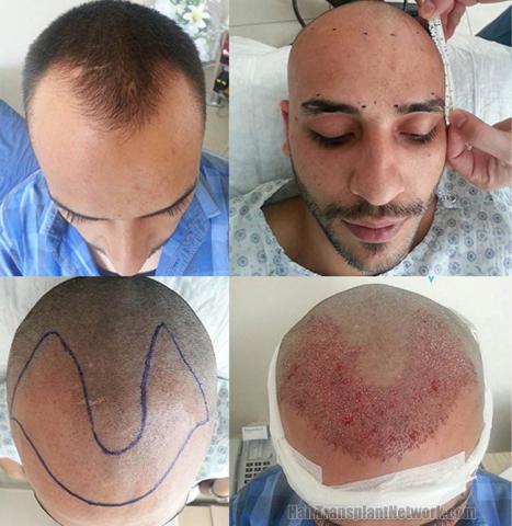 Hair transplantation surgery before and after images