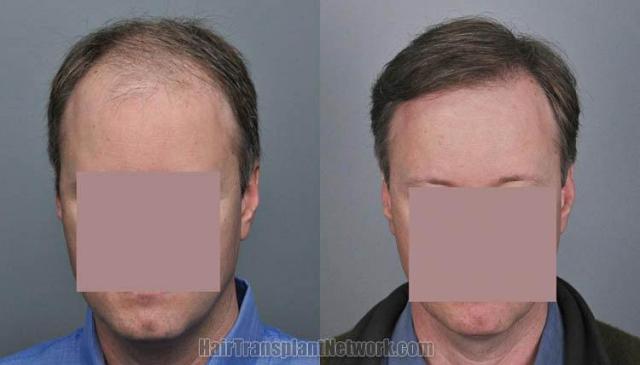 Hair restoration procedure before and after results