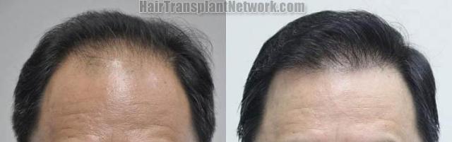 Hair restoration procedure before and after results