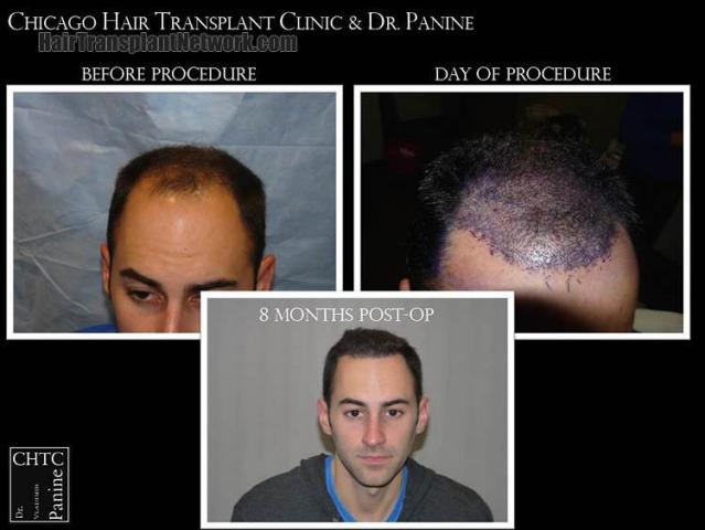 Hair restoration procedure before and after results