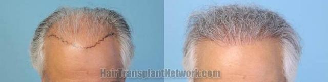 Before and after hair transplant procedure images