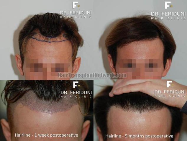 Hair restoration procedure before and after results