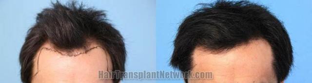 Hair restoration procedure before and after results