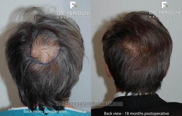 Hair restoration procedure before and after pictures