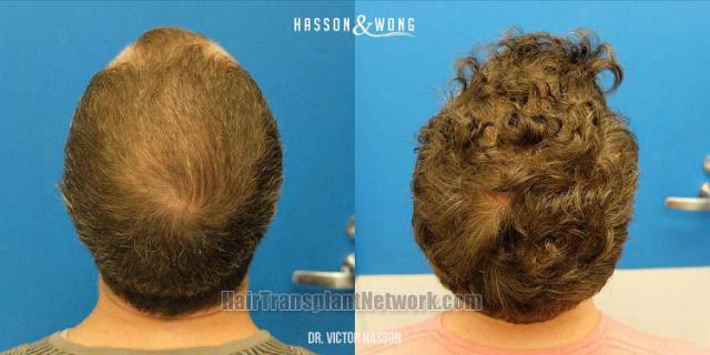 Hair restoration procedure before and after pictures