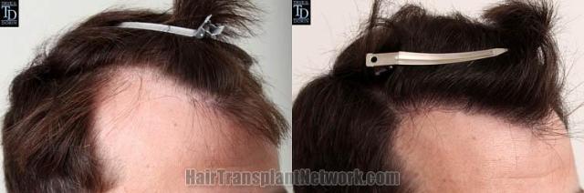 Hair transplantation surgery before and after pictures