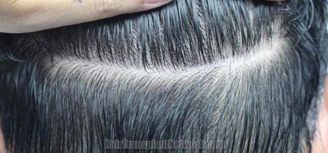 Hair restoration procedure before and after pictures