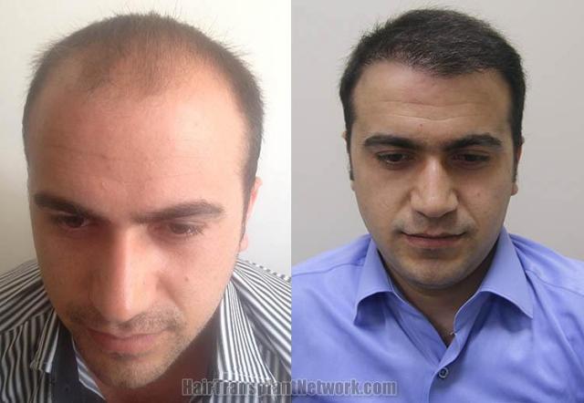 Front view - Before and after hair transplant surgery result images