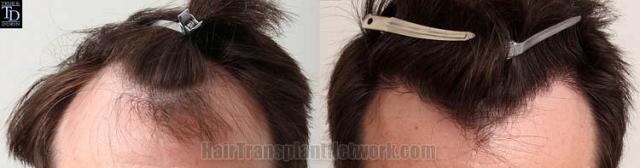 Hair restoration procedure before and after results