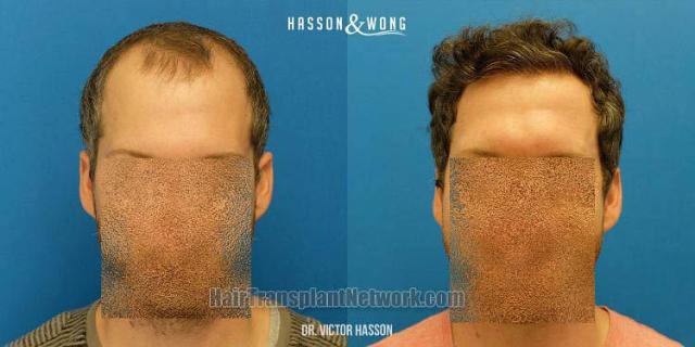 Hair restoration procedure before and after results