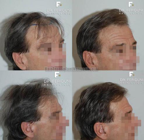 Hair transplantation surgery before and after images