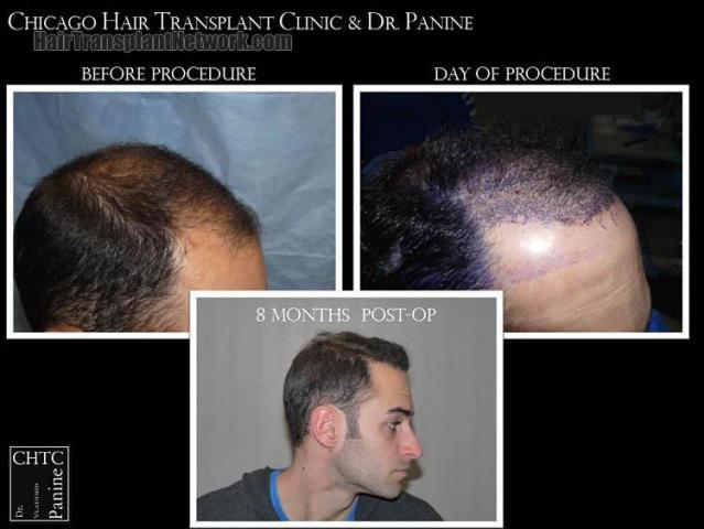 Hair transplantation surgery before and after images