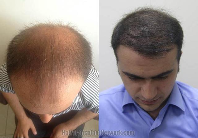 Hair restoration procedure before and after pictures