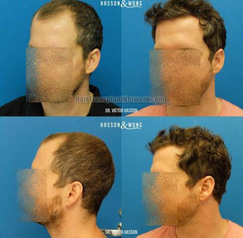 Hair transplantation surgery before and after pictures