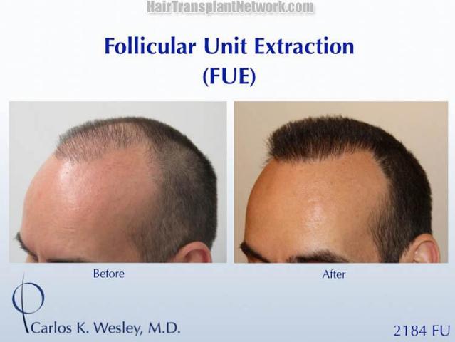 Hair transplantation surgery before and after pictures