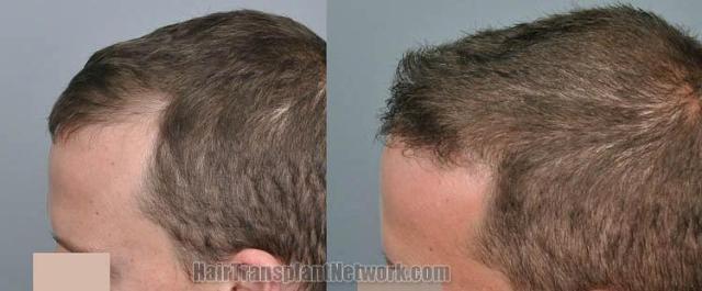 Hair transplantation surgery before and after images