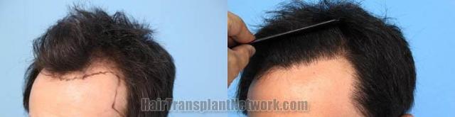 Hair transplantation surgery before and after pictures