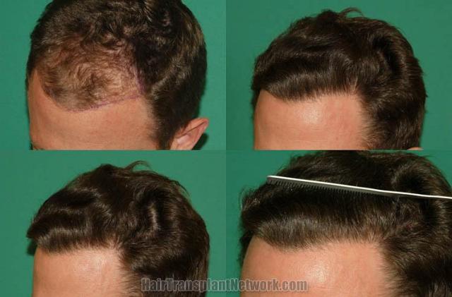 Hair transplantation surgery before and after images