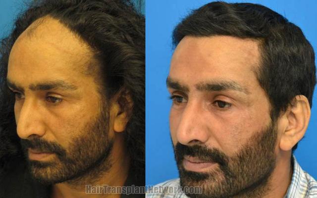 Hair restoration surgery before and after photos