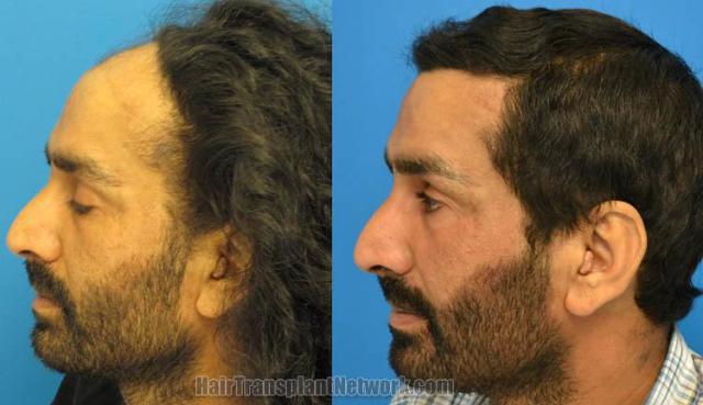 Hair transplantation surgery before and after pictures