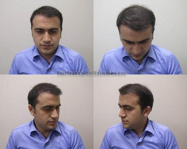 Hair restoration procedure before and after result photographs