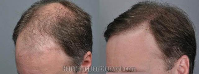 Hair transplantation surgery before and after images