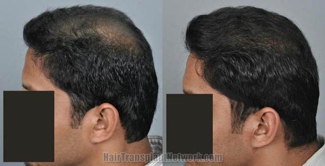 Hair transplantation surgery before and after images