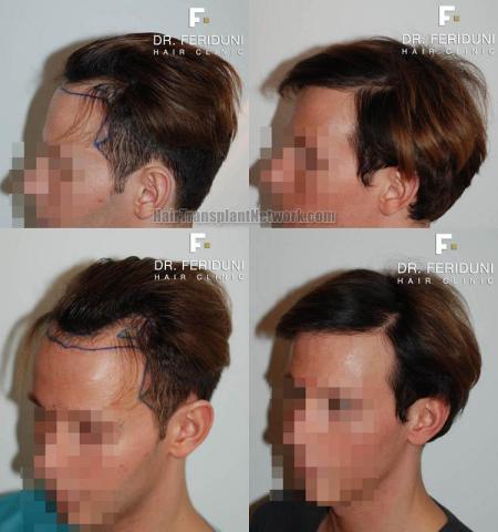 Hair transplantation surgery before and after images