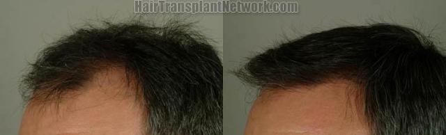 Hair restoration procedure results