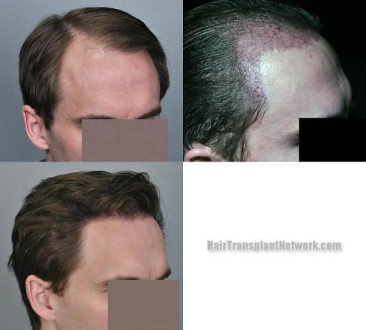 Hair transplantation surgery before and after pictures