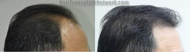 Hair transplantation surgery before and after images