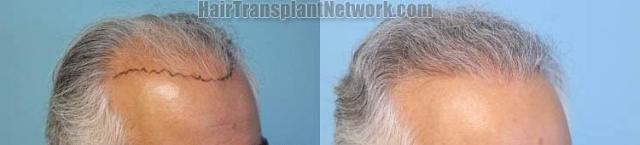 Hair transplantation surgery before and after photos