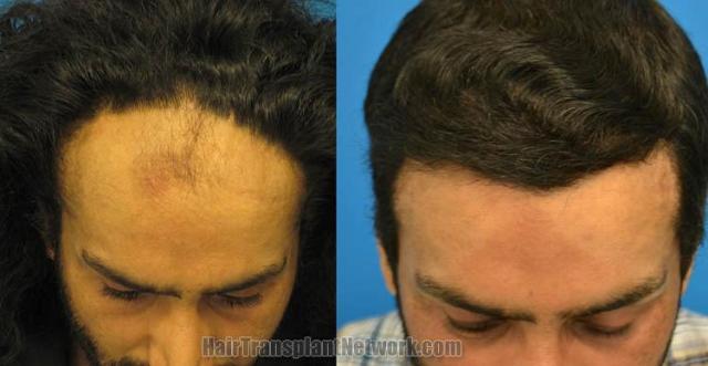 Hair transplantation surgery before and after photos