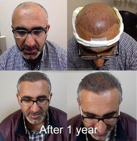 Hair restoration procedure before and after results