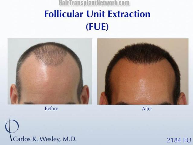 Before and after hair transplant procedure images