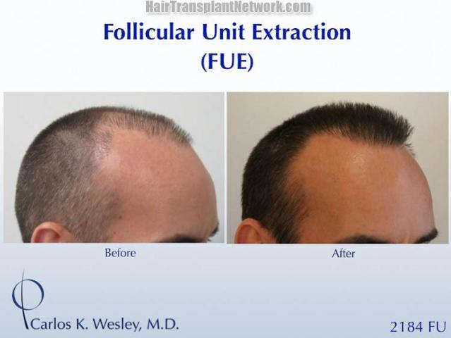 Hair transplantation surgery before and after photos