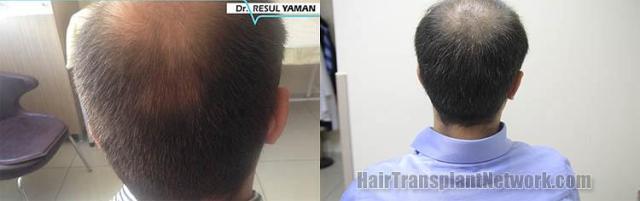 Hair restoration procedure before and after pictures