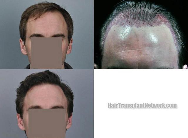 Hair transplantation surgery before and after photos