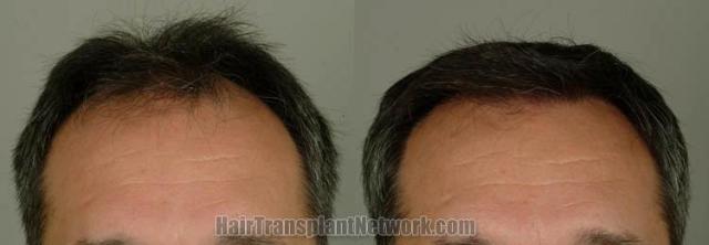 Hair restoration procedure before and after results