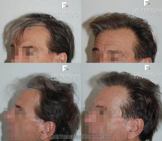 Hair transplantation surgery before and after pictures