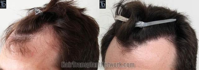 Hair transplantation surgery before and after images