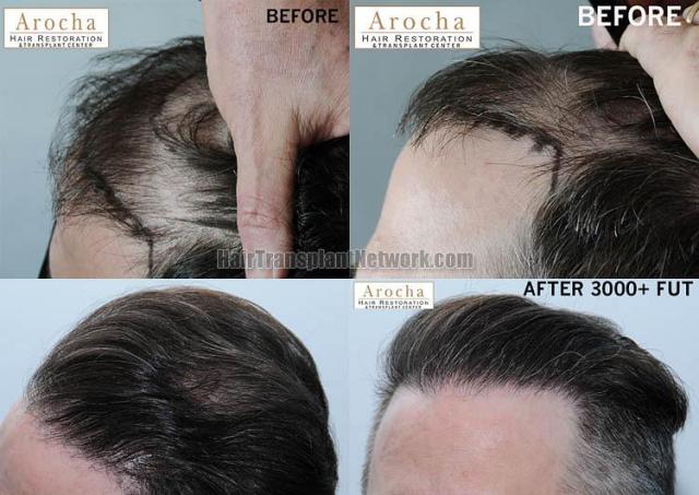 Hair transplantation surgery before and after pictures