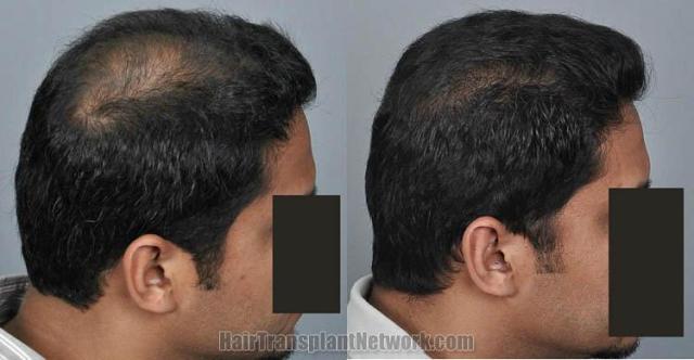 Hair transplantation surgery before and after photos