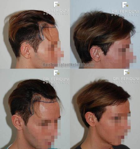 Hair transplantation surgery before and after photos