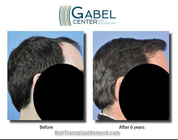 Hair transplantation surgery before and after images