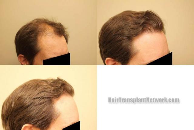 Hair transplantation surgery before and after photos